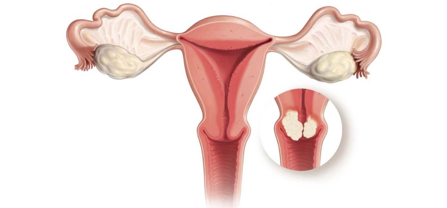 Diagnóstico de Cáncer Cervicouterino en Guadalajara