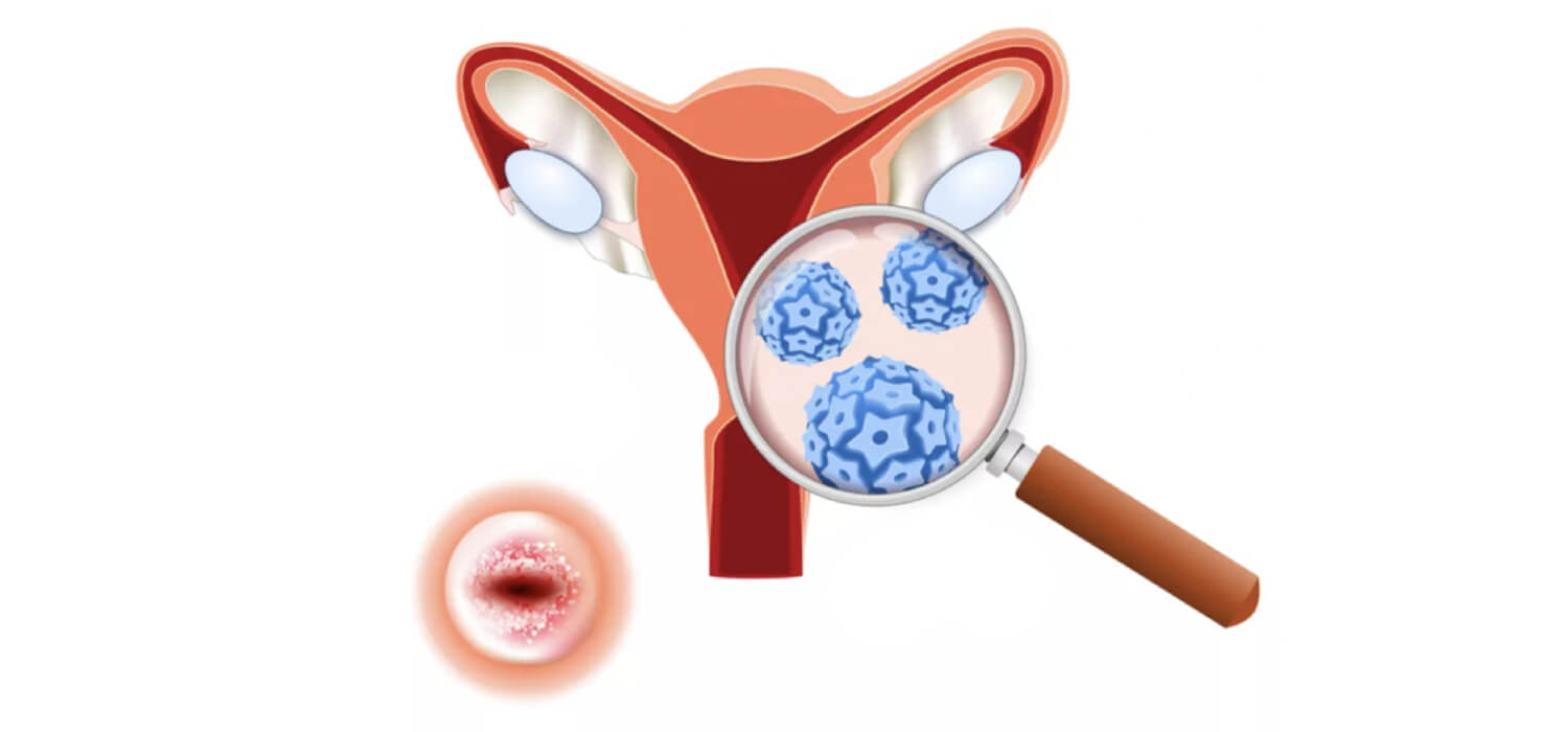 Diagnóstico de Lesiones Precancerosas en Guadalajara